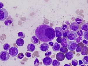 Chronic myeloid leukaemia V16H05