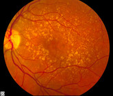 Age-related macular degeneration V15b19