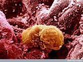 Cancer image015